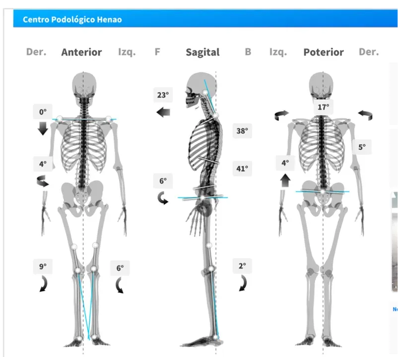Análisis postural y biomecánico de paciente pediátrico con hiperlaxitud realizado en Centro Podológico Henao, Bilbao