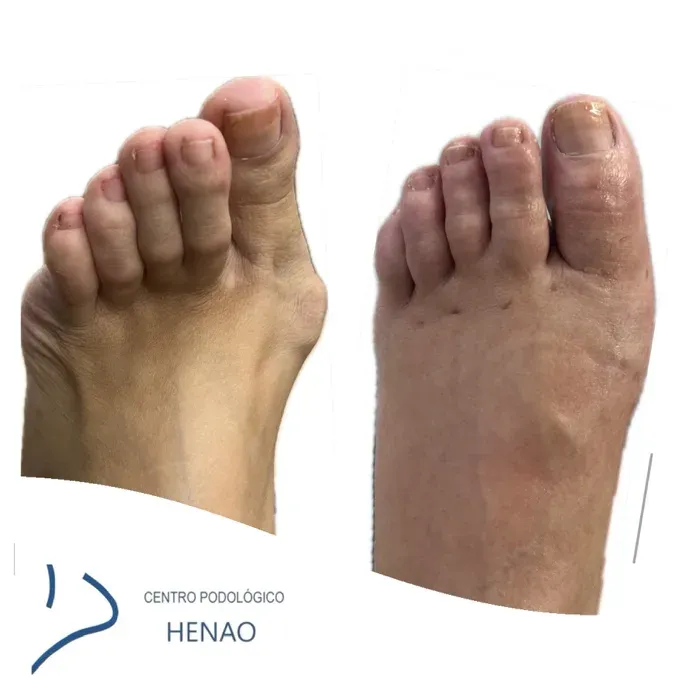 Comparativa antes y después de la corrección del hallux valgus vista dorsal