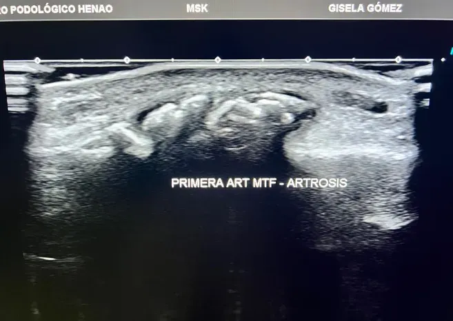 Articulación del pie afectada por artrosis mostrando desgaste del cartílago y cambios óseos