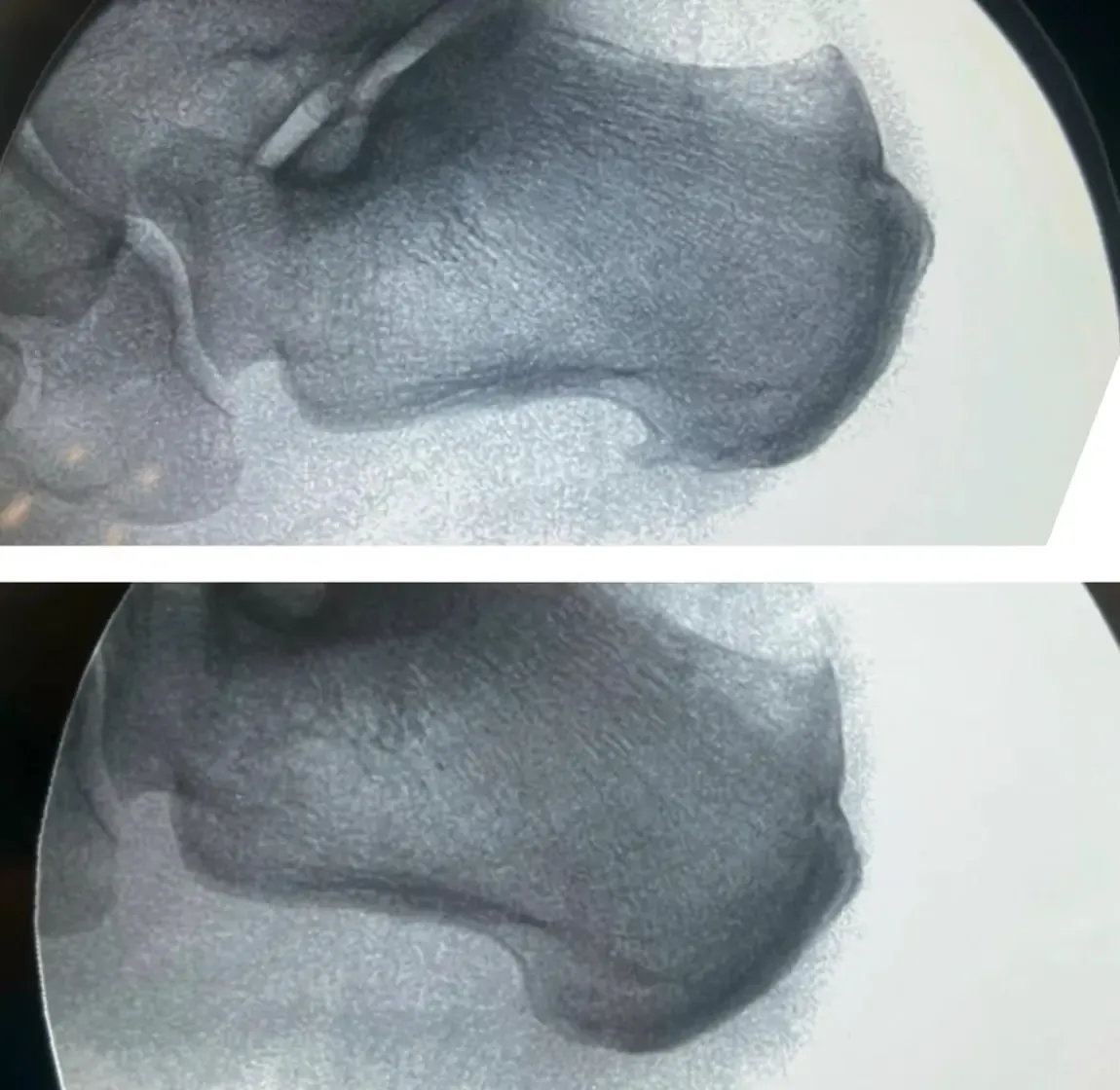 Ecografía del tendón de Aquiles y bursa retrocalcánea mostrando inflamación en la zona del talón