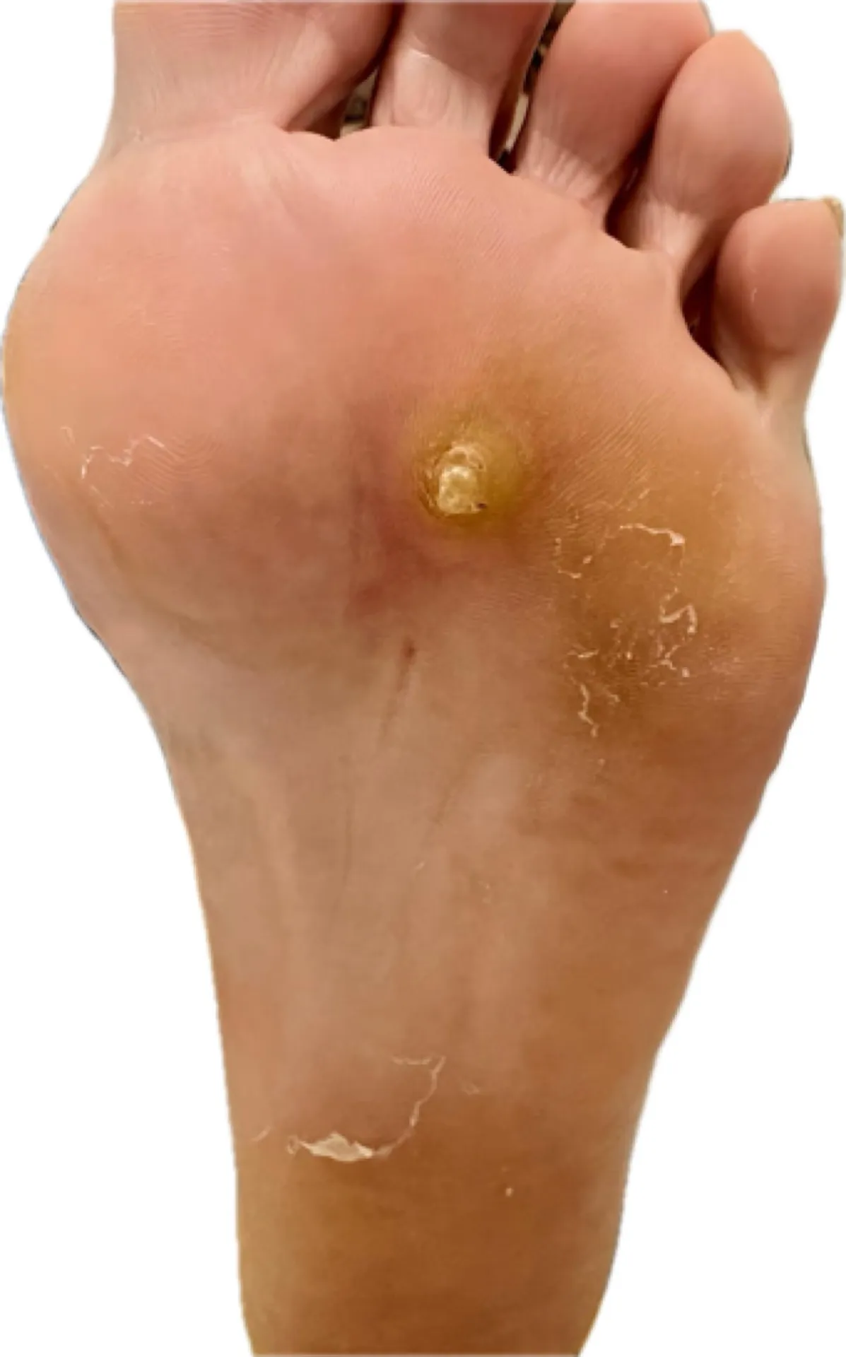 Queratosis plantar intratable en planta del pie antes del tratamiento con láser podológico