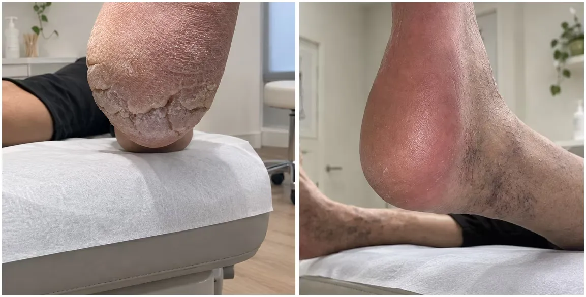 Comparativa antes y después de un talón con grietas profundas tratado en el Centro Podológico Henao