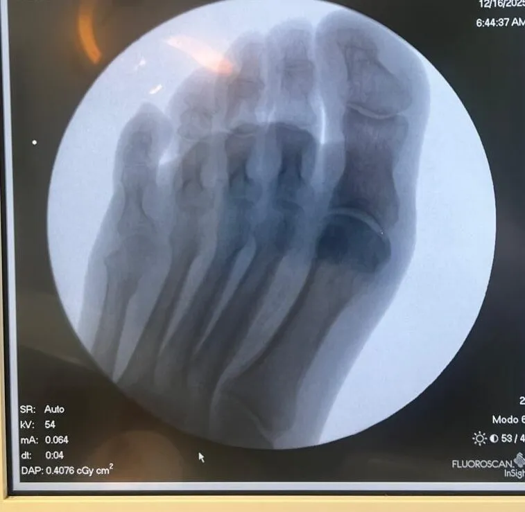 Imagen radiográfica del pie mostrando alteración ósea adyacente asociada con úlcera interdigital avanzada