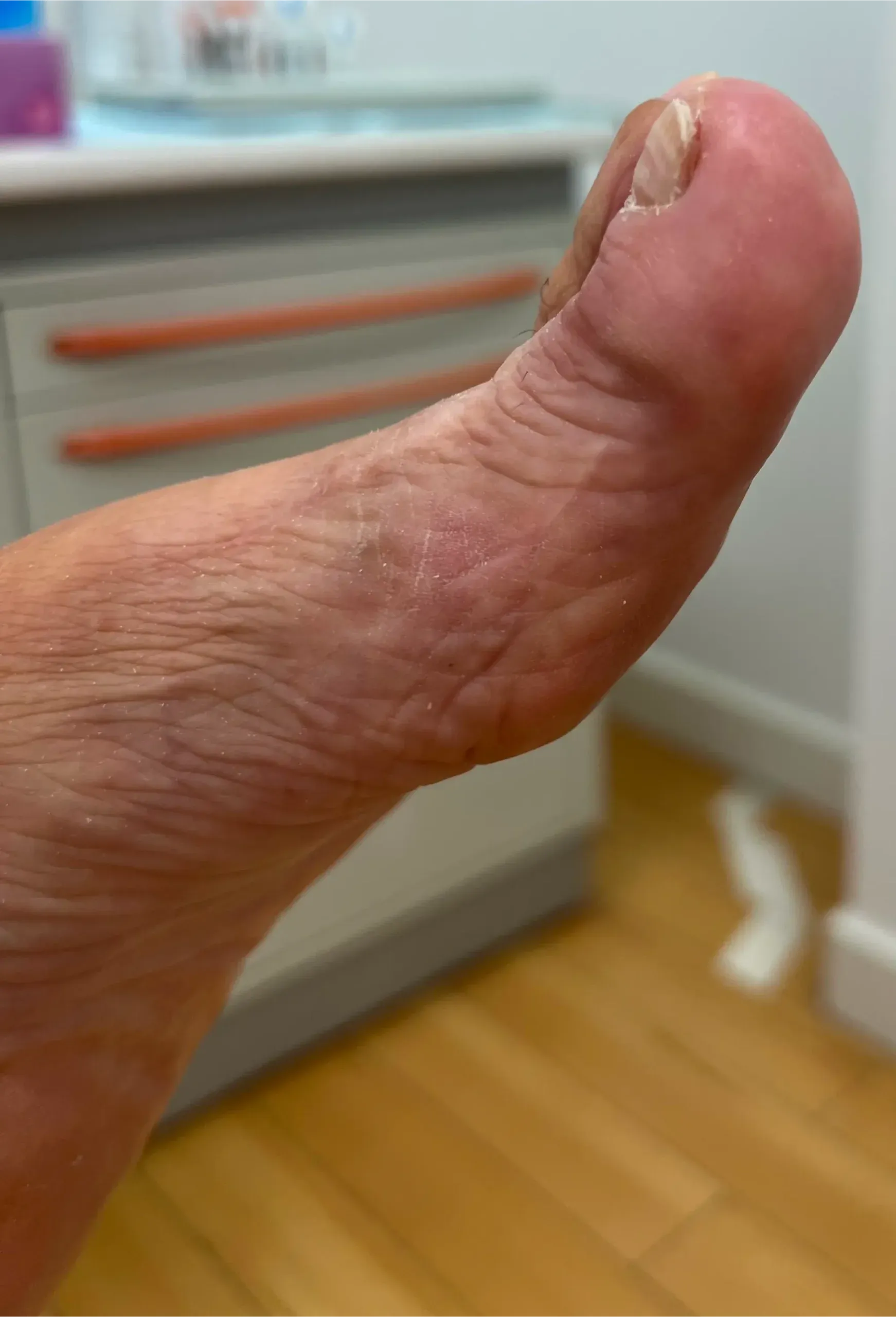 Caso clínico de hongos en las uñas tratado con láser en Centro Podológico Henao