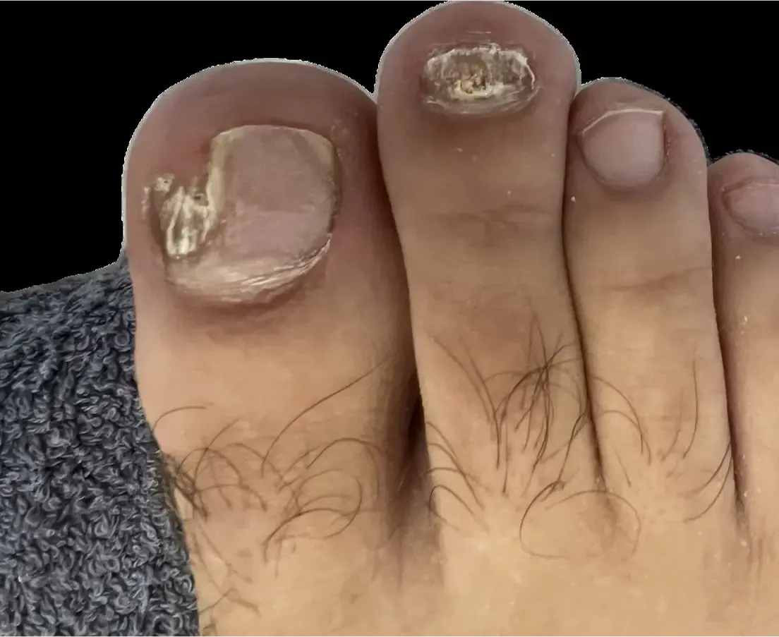 Resultado del tratamiento de hongos en los pies en Centro Podológico Henao