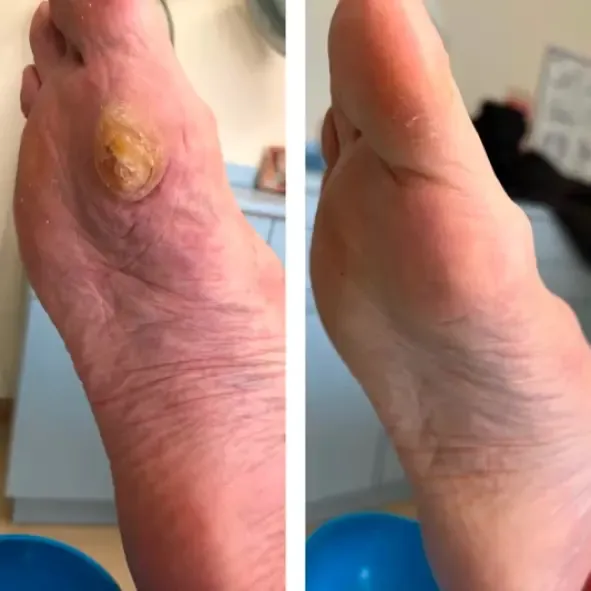 Primer dedo del pie antes y después de cirugía láser para uña encarnada recurrente