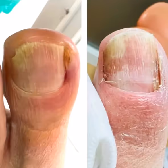 Resultado post tratamiento de cirugía láser podológica en Bilbao