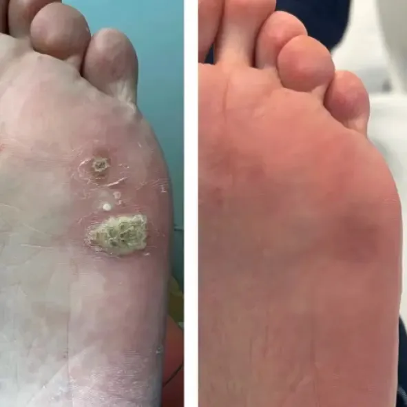 Verruga plantar antes y después de la cirugía láser podológica en Centro Podológico Henao Bilbao