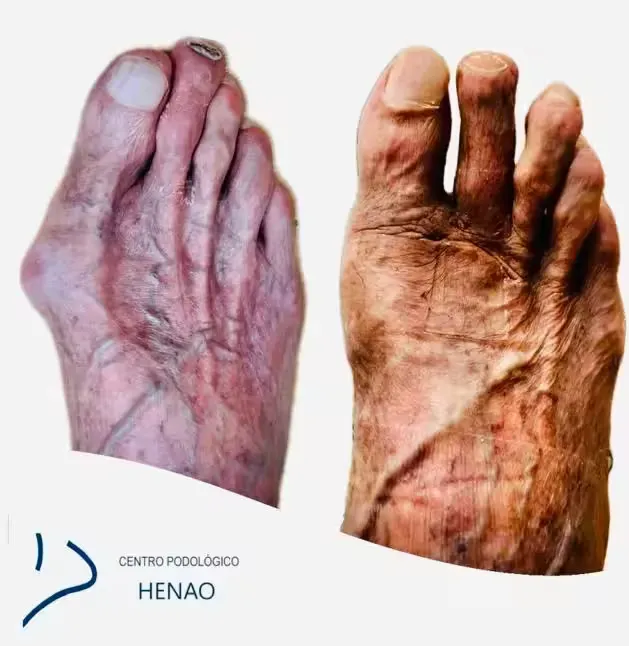 Dedos del pie antes y después de una cirugía mínimamente invasiva en Centro Podológico Henao Bilbao