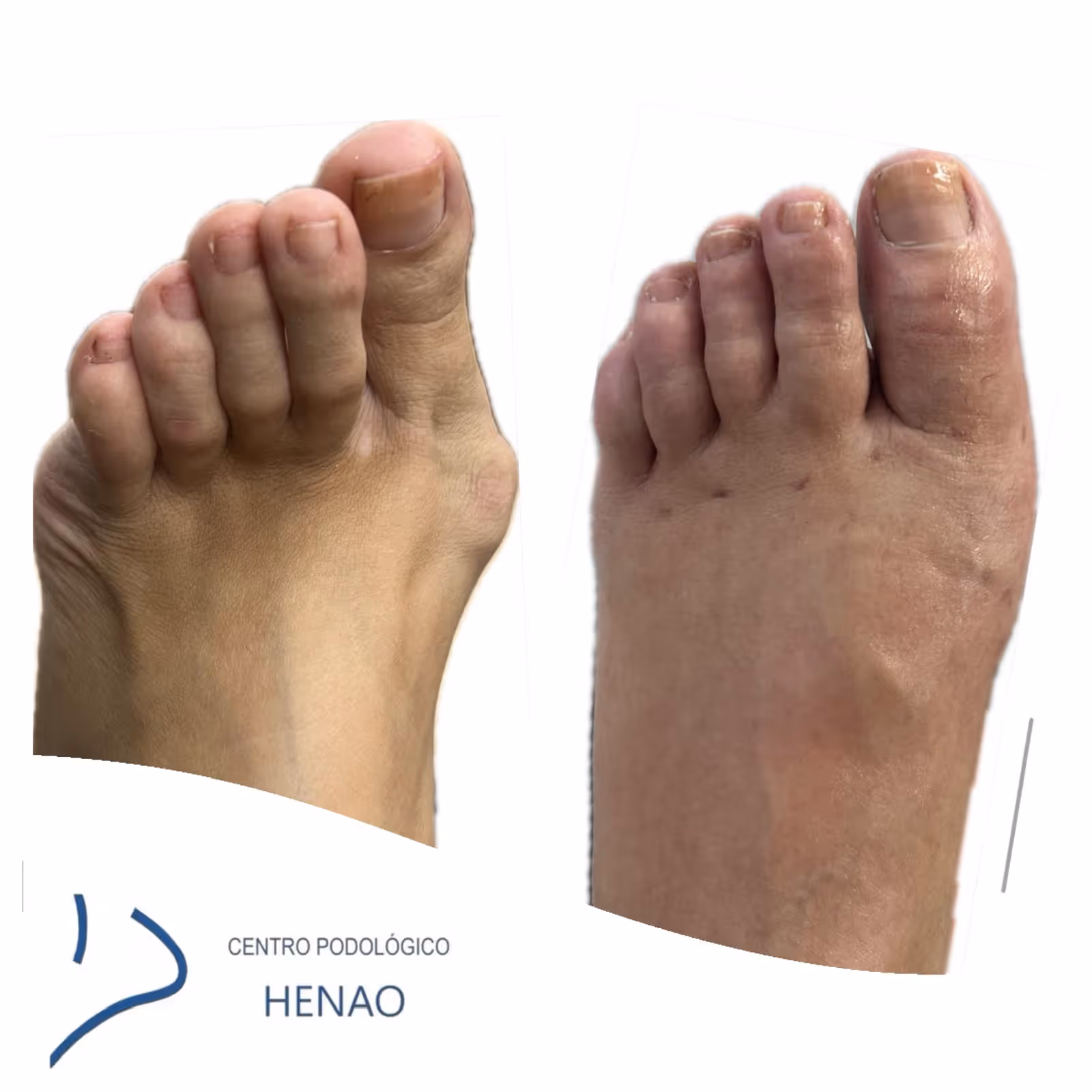 Pies antes y después de la cirugía mínimamente invasiva de juanetes en Centro Podológico Henao, Bilbao