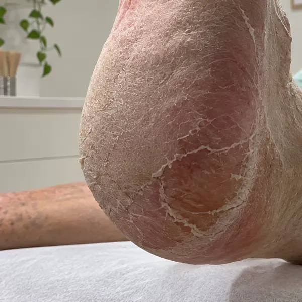 Vista lateral de un talón con grietas e hiperqueratosis, fotografía clínica del Centro Podológico Henao