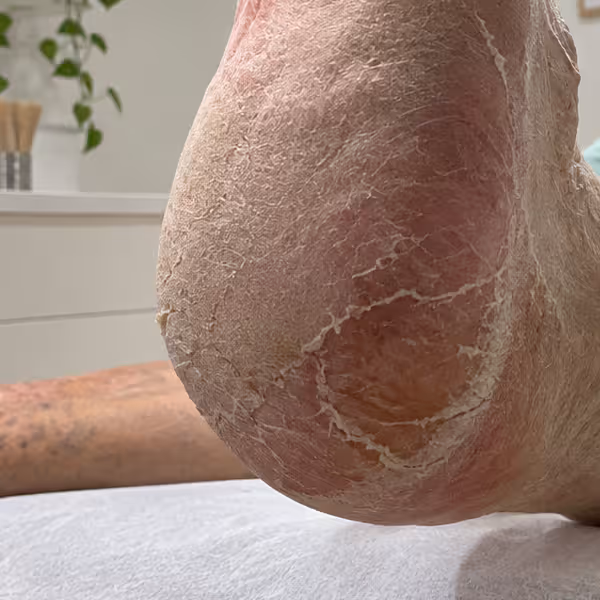 Vista lateral de un talón con grietas e hiperqueratosis, fotografía clínica del Centro Podológico Henao