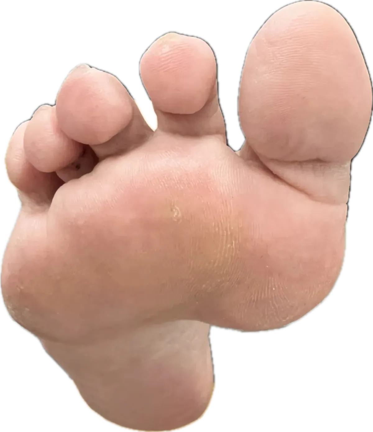 Cuerpo extraño en el pie: zona de lesión en planta antes del diagnóstico en Centro Podológico Henao Bilbao