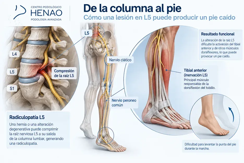 Infografía que muestra cómo una lesión en la raíz L5 de la columna lumbar puede producir un pie caído