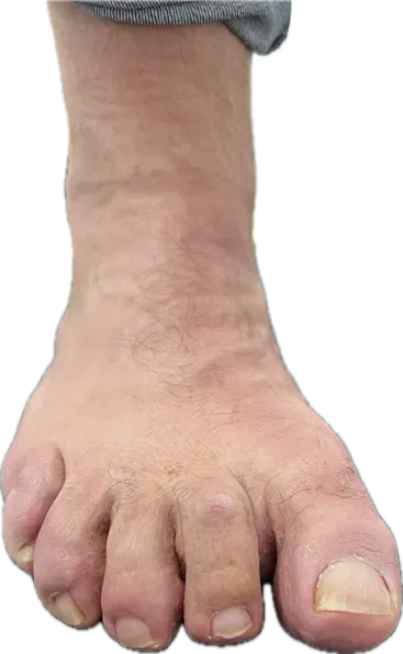 Exploración clínica mostrando deformidad digital en garra en ambos pies del paciente