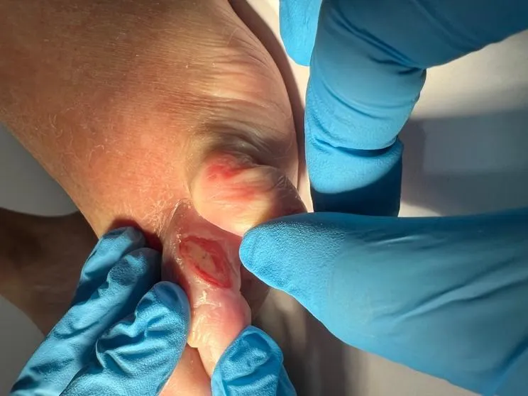 Dolor entre los Dedos