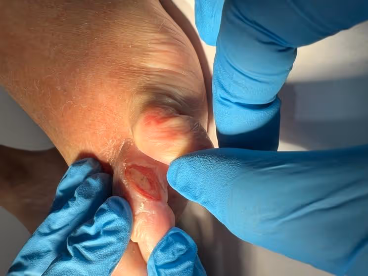 Perfil de paciente geriátrico de 84 años con diabetes tipo 2 y úlcera interdigital