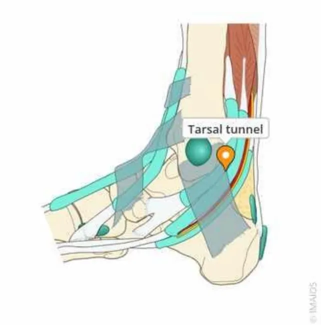 Hidrodisección ecoguiada del nervio tibial a nivel maleolar para tratamiento del dolor neuropático del talón, en consulta de podología en Bilbao