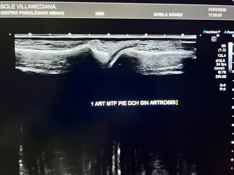 Imagen ecográfica de una articulación del pie con artrosis mostrando irregularidades del cartílago y osteofitos incipientes