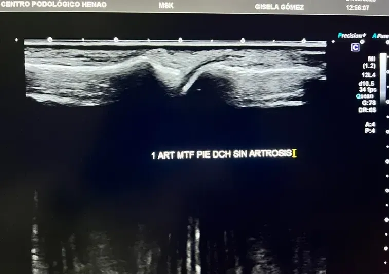 Imagen ecográfica de una articulación del pie con artrosis mostrando irregularidades del cartílago y osteofitos incipientes
