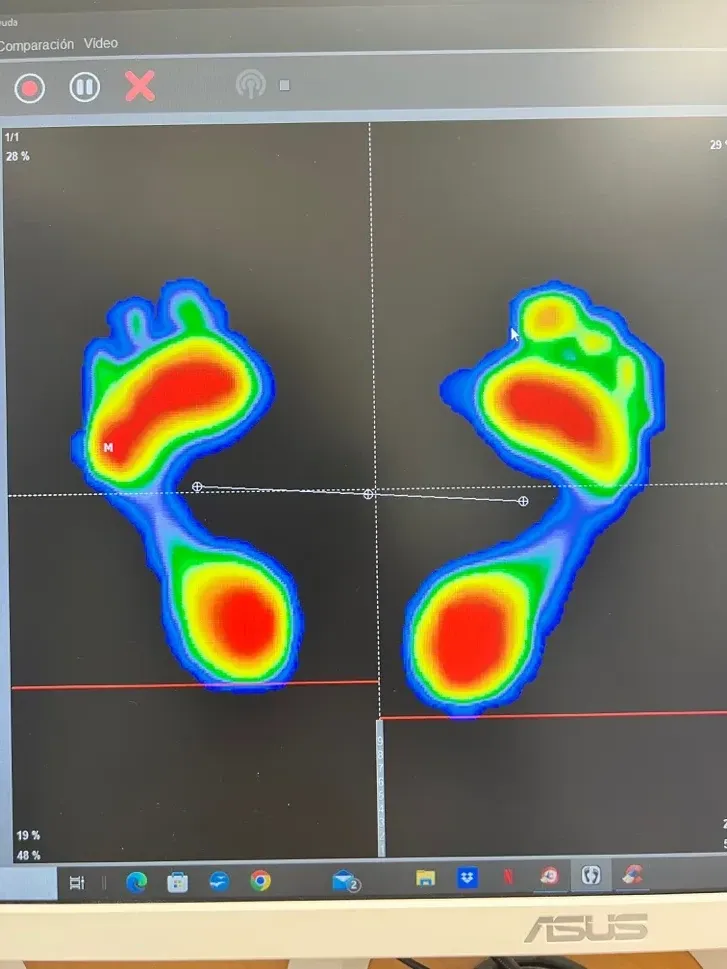 Ecografía musculoesquelética mostrando atrofia del panículo adiposo plantar