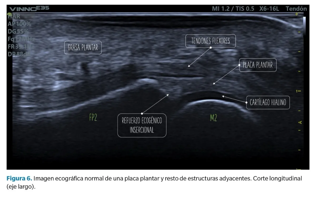 Ecografía musculoesquelética placa plantar normal con estructuras anatómicas identificadas corte longitudinal