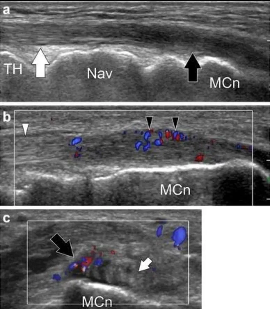 Imagen ecográfica de la zona de inserción del tendón tibial anterior mostrando una división en dos haces, variante anatómica que modifica el reparto de cargas