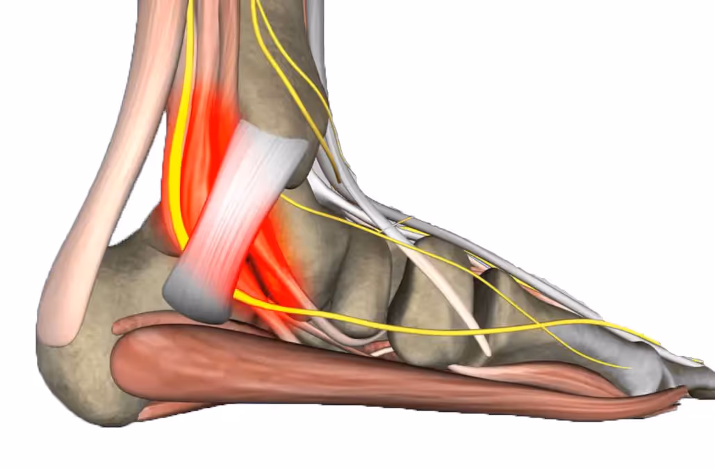 Exploración del nervio tibial posterior en un paciente con síndrome del túnel tarsiano