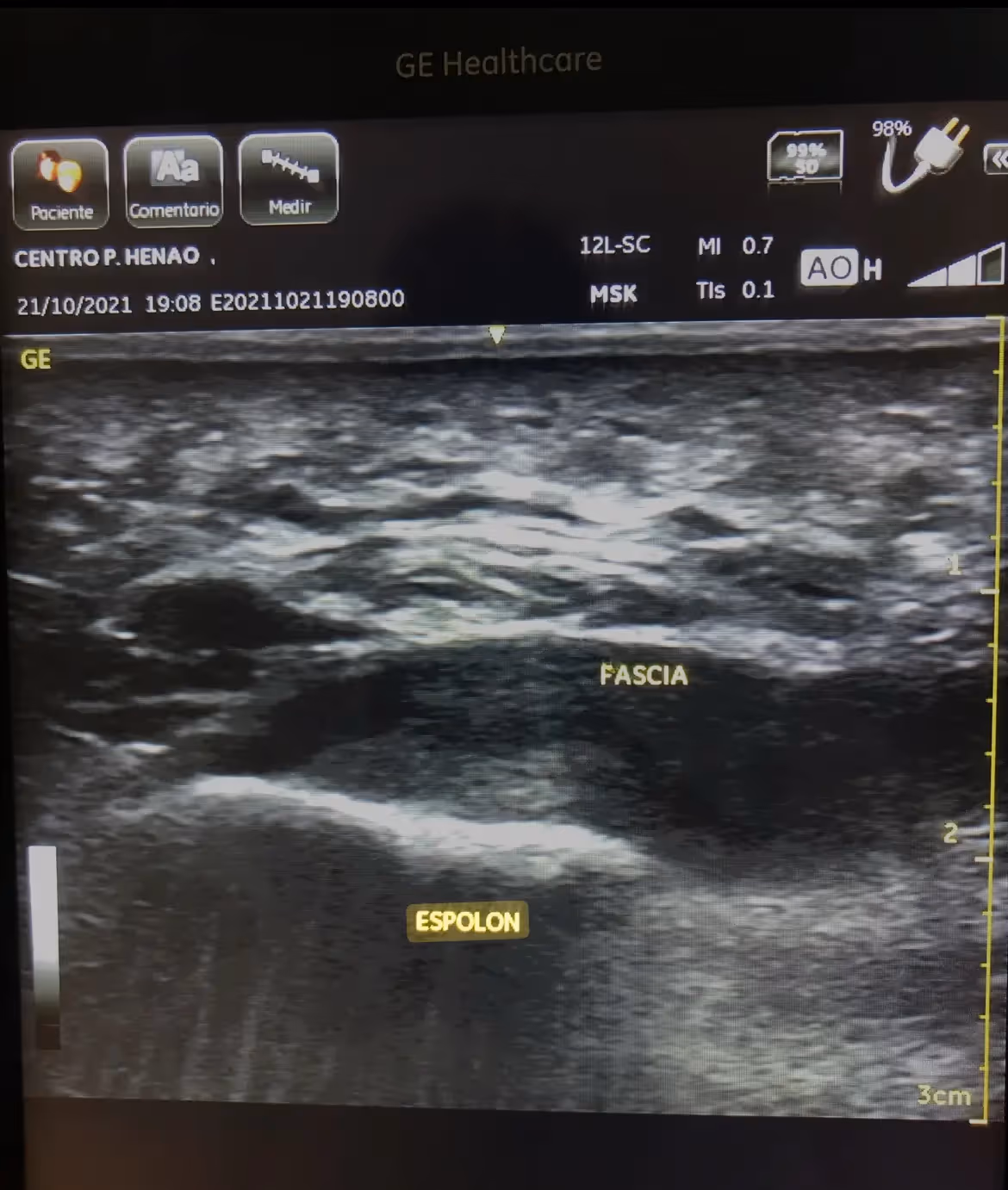 Radiografía lateral de pie mostrando espolón calcáneo comparada con ecografía de fascia plantar