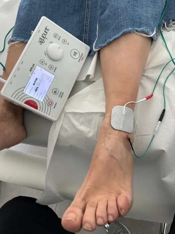 Aplicación de electrólisis percutánea bajo control ecográfico sobre la inserción del tendón tibial anterior en consulta de podología en Bilbao