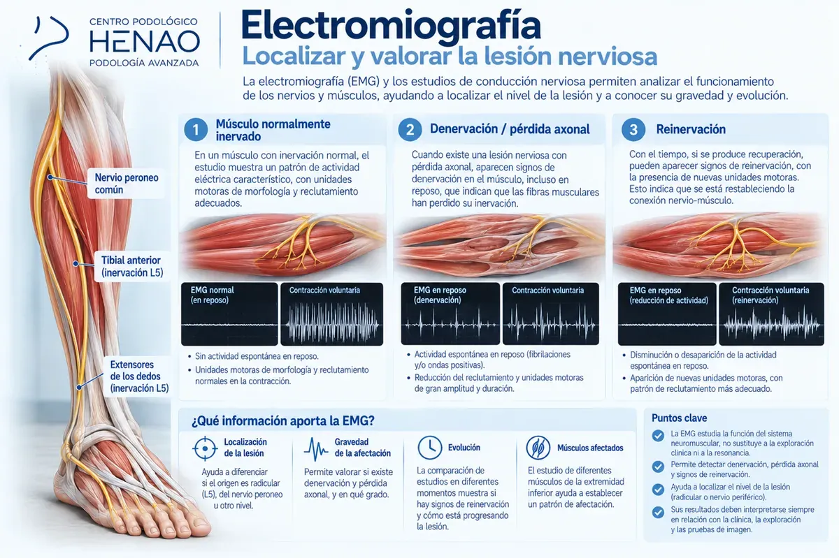 Infografía sobre la electromiografía en el estudio del pie caído