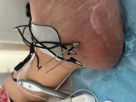 Electrólisis percutánea ecoguiada para fascitis plantar en Centro Podológico Henao