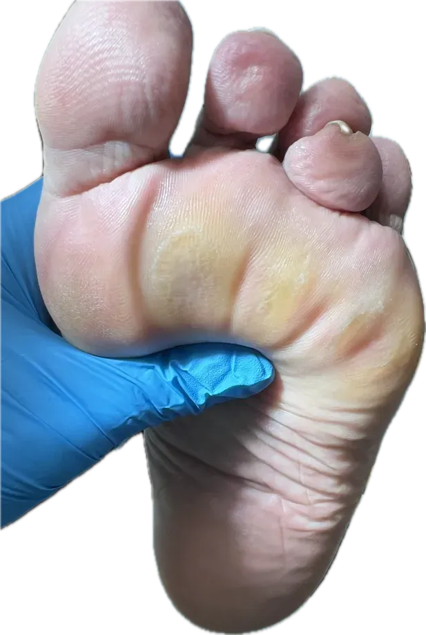 Estudio biomecánico de la marcha mostrando sobrecarga en antepié