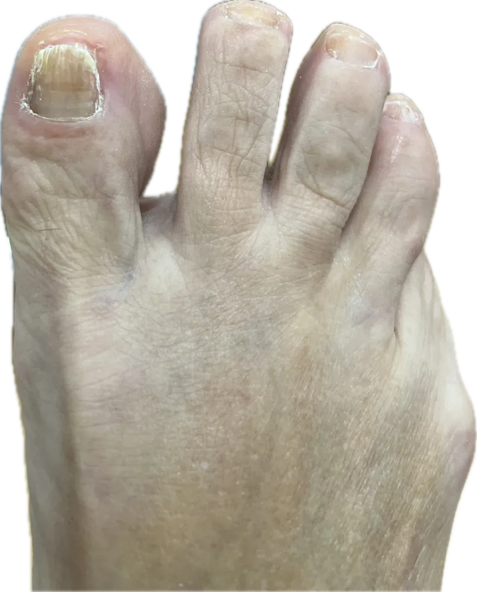 Evolución de las uñas del pie tras la cirugía y el láser: uñas de los dedos pequeños finas y uña del dedo gordo en crecimiento