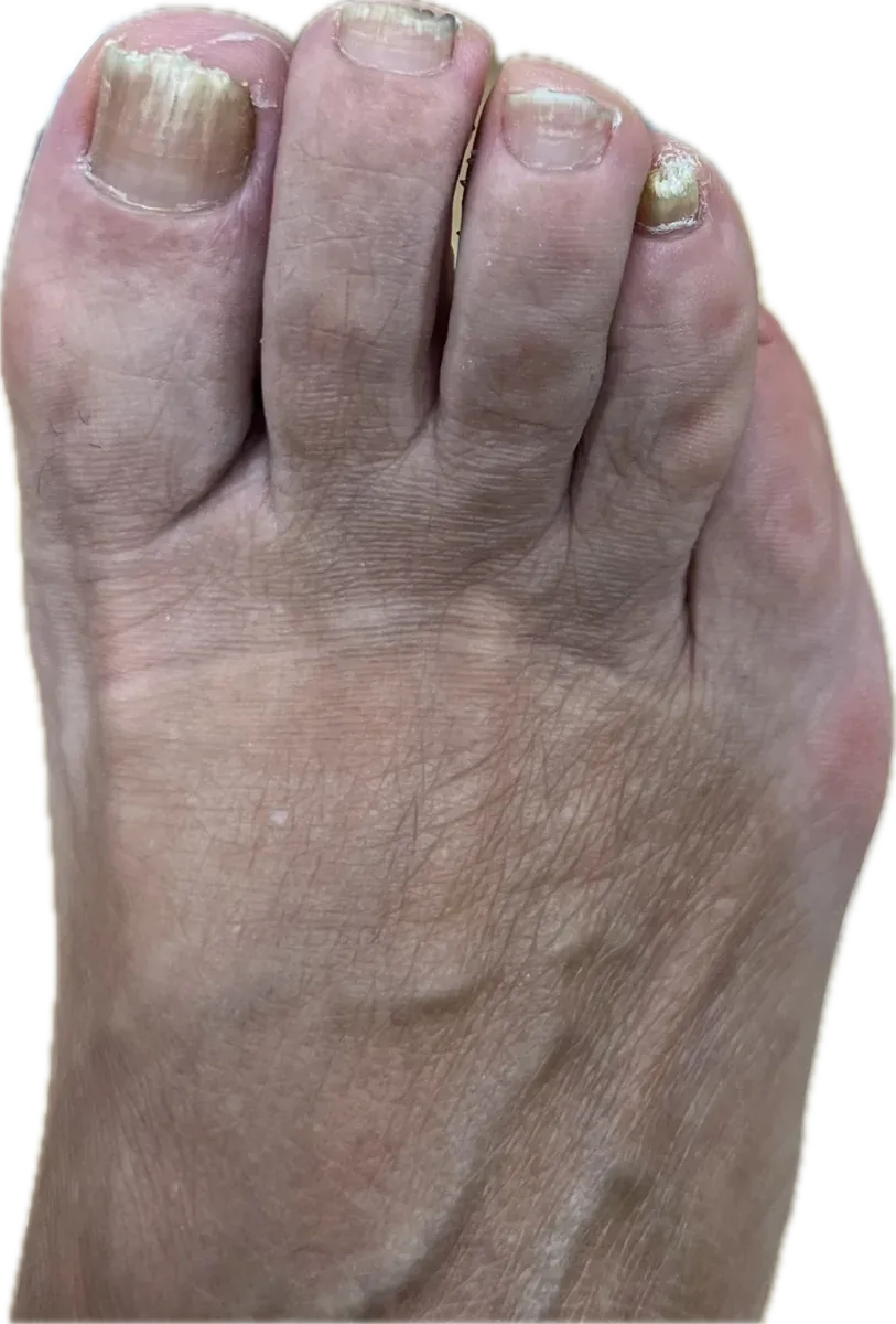 Evolución de las uñas del pie tras el tratamiento de una onicomicosis mixta, con uñas más finas y la del dedo gordo aún con estrías