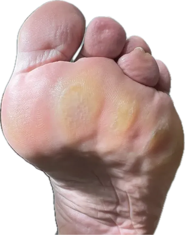 Hiperqueratosis plantar marcada en antepié de paciente diabético