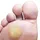 Heloma y Clavo Plantar