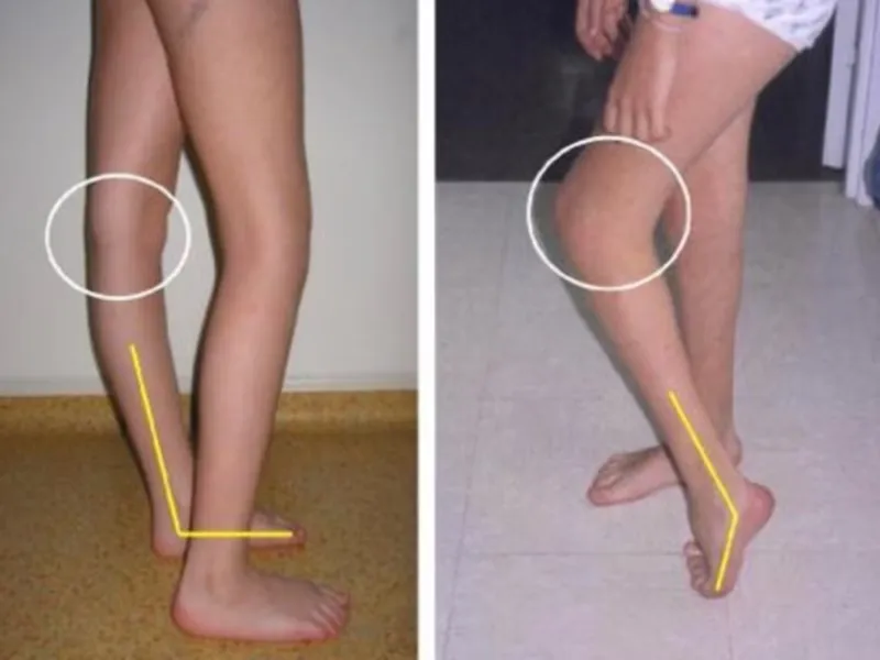 Exploración clínica de piernas con genu valgum y pronación en niño valorado en Centro Podológico Henao, Bilbao