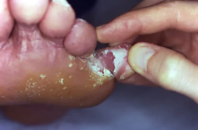 Dermatomicosis plantar tipo mocasín con descamación difusa en la planta del pie
