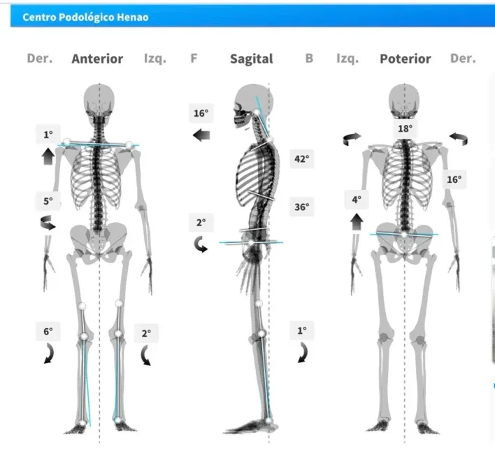 Informe de análisis postural biomecánico de Centro Podológico Henao con mediciones angulares en planos anterior, sagital y posterior tras cirugía de cadera