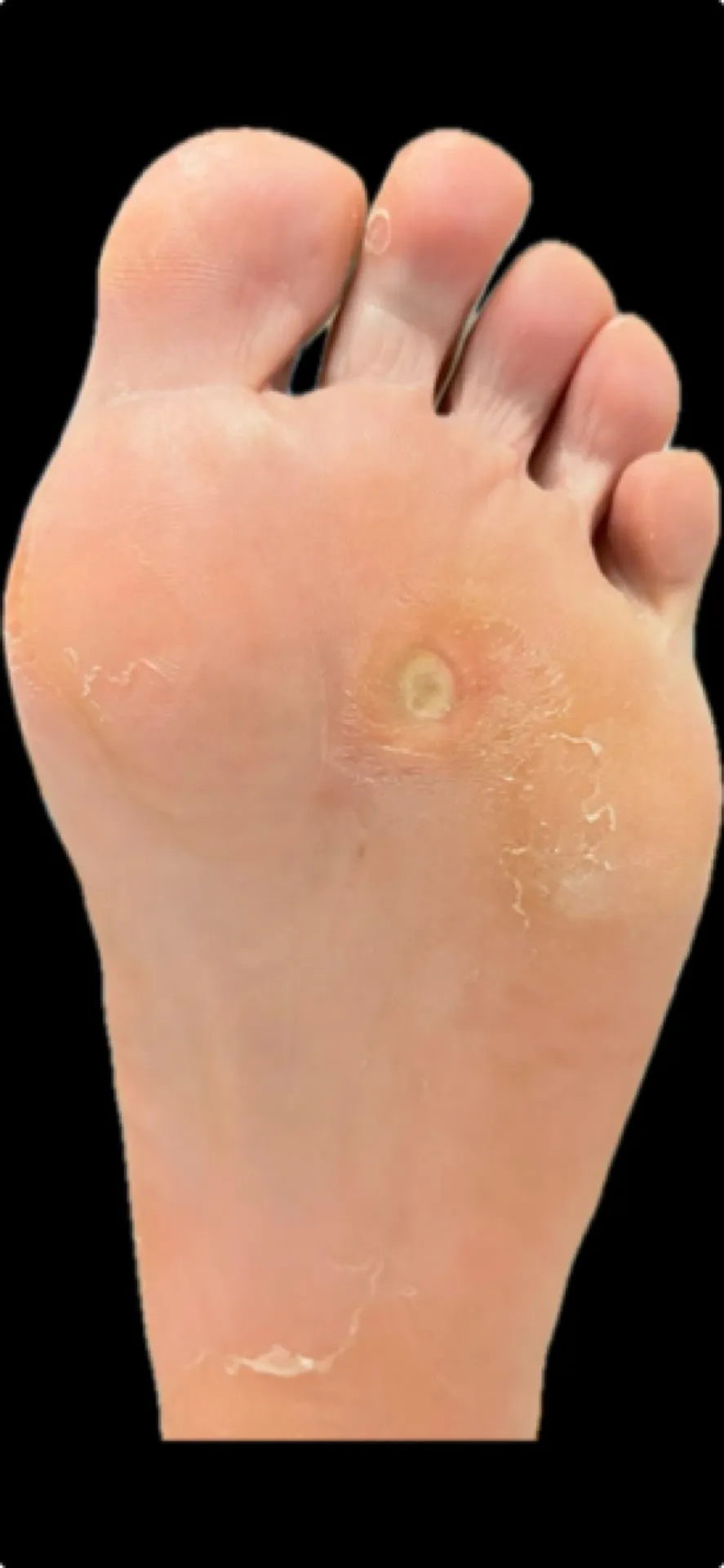 Aspecto clínico inicial del pie derecho