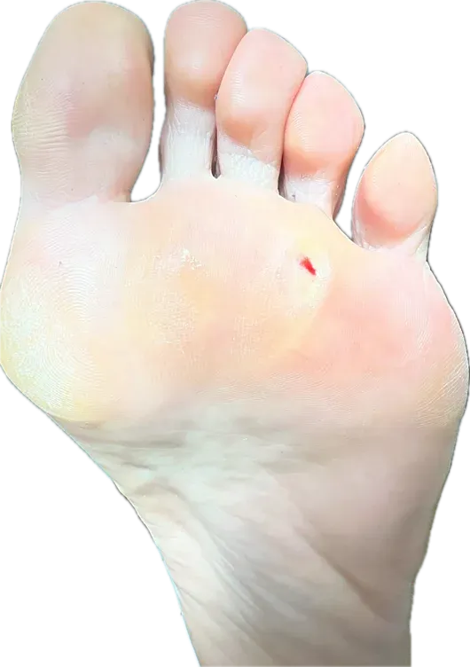 Lesión plantar en la consulta inicial: aspecto clínico que genera duda diagnóstica entre heloma y verruga plantar