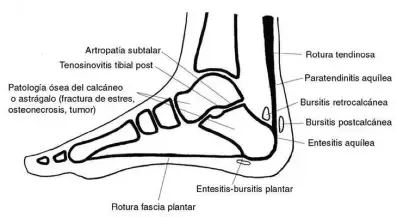 Zona del talón afectada por fascitis plantar