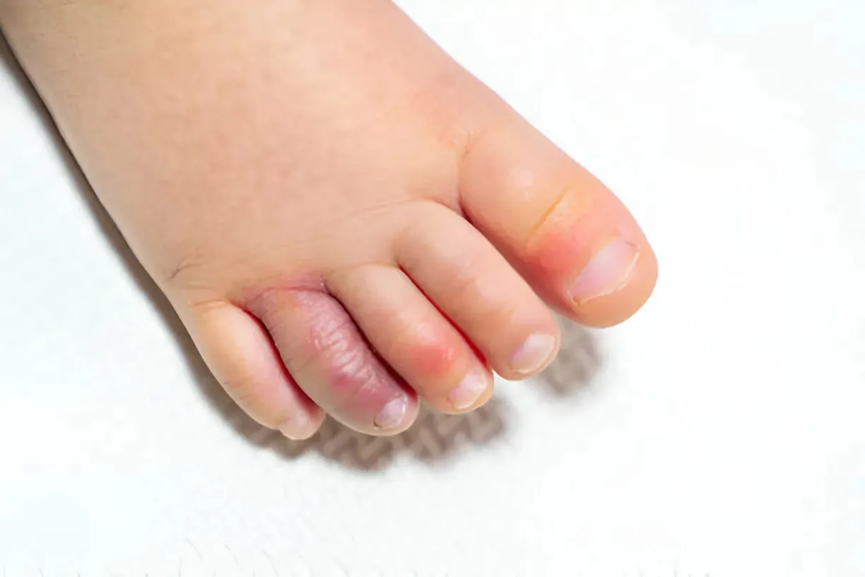 Sabañones en los dedos de los pies mostrando enrojecimiento característico