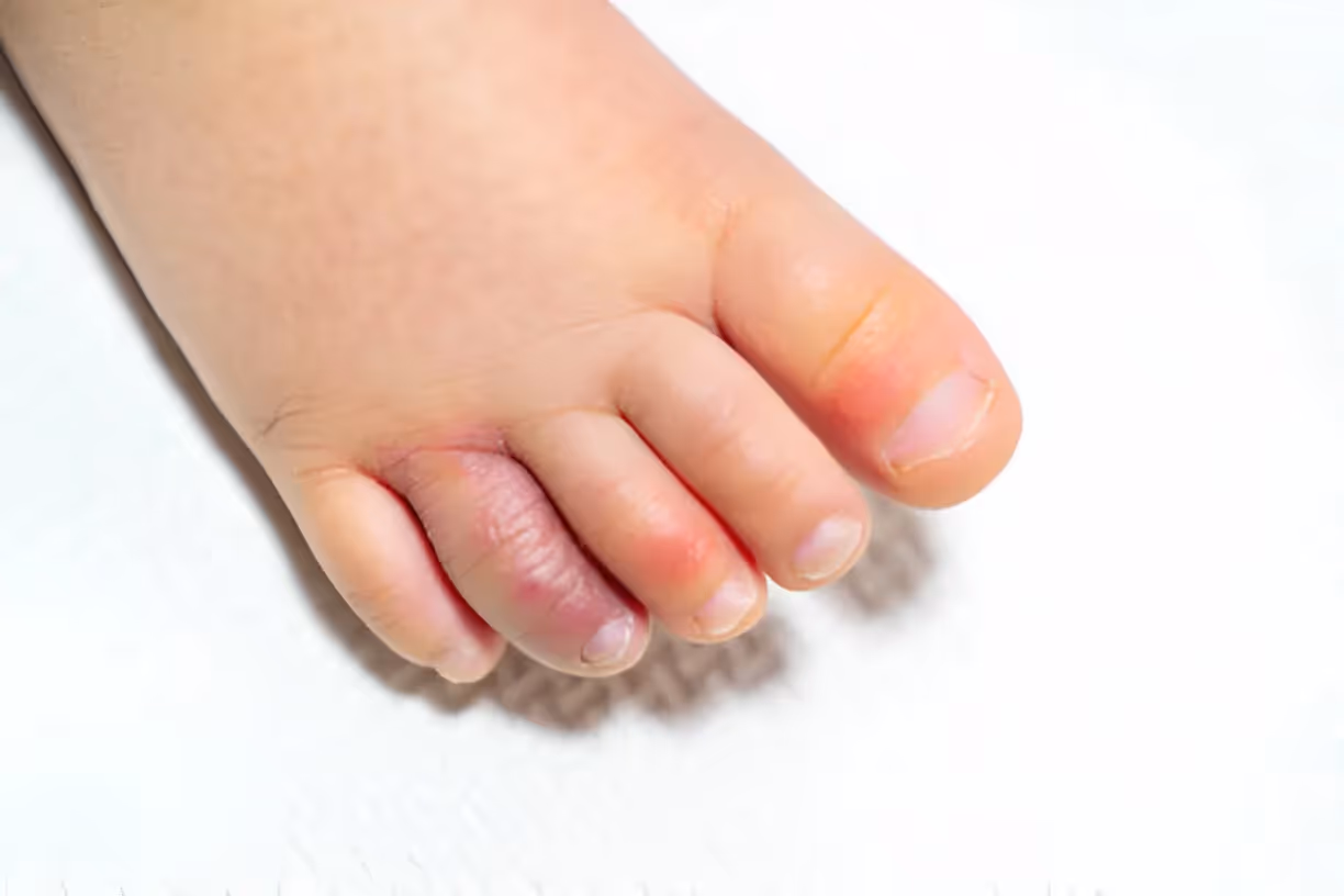 Sabañones en los dedos de los pies mostrando enrojecimiento característico