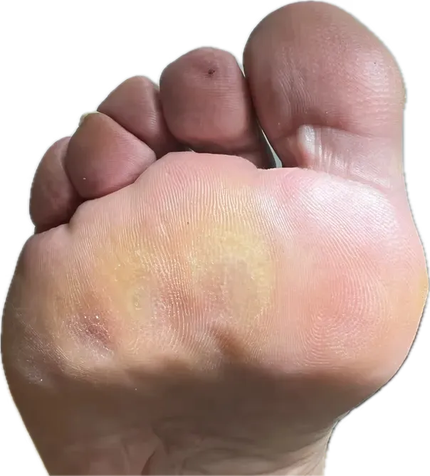 Paciente diabético en consulta podológica por metatarsalgia bilateral en Bilbao