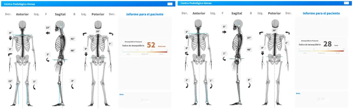 Comparativa de los dos informes de MotiPhysio: 52 puntos en la medición inicial frente a 28 puntos en la nueva medición