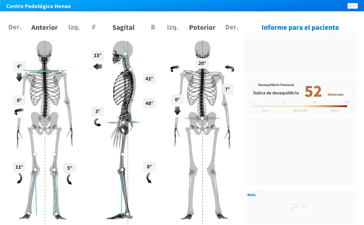 Informe de MotiPhysio de la medición inicial con un índice de desequilibrio postural de 52 puntos, con los datos personales ocultos