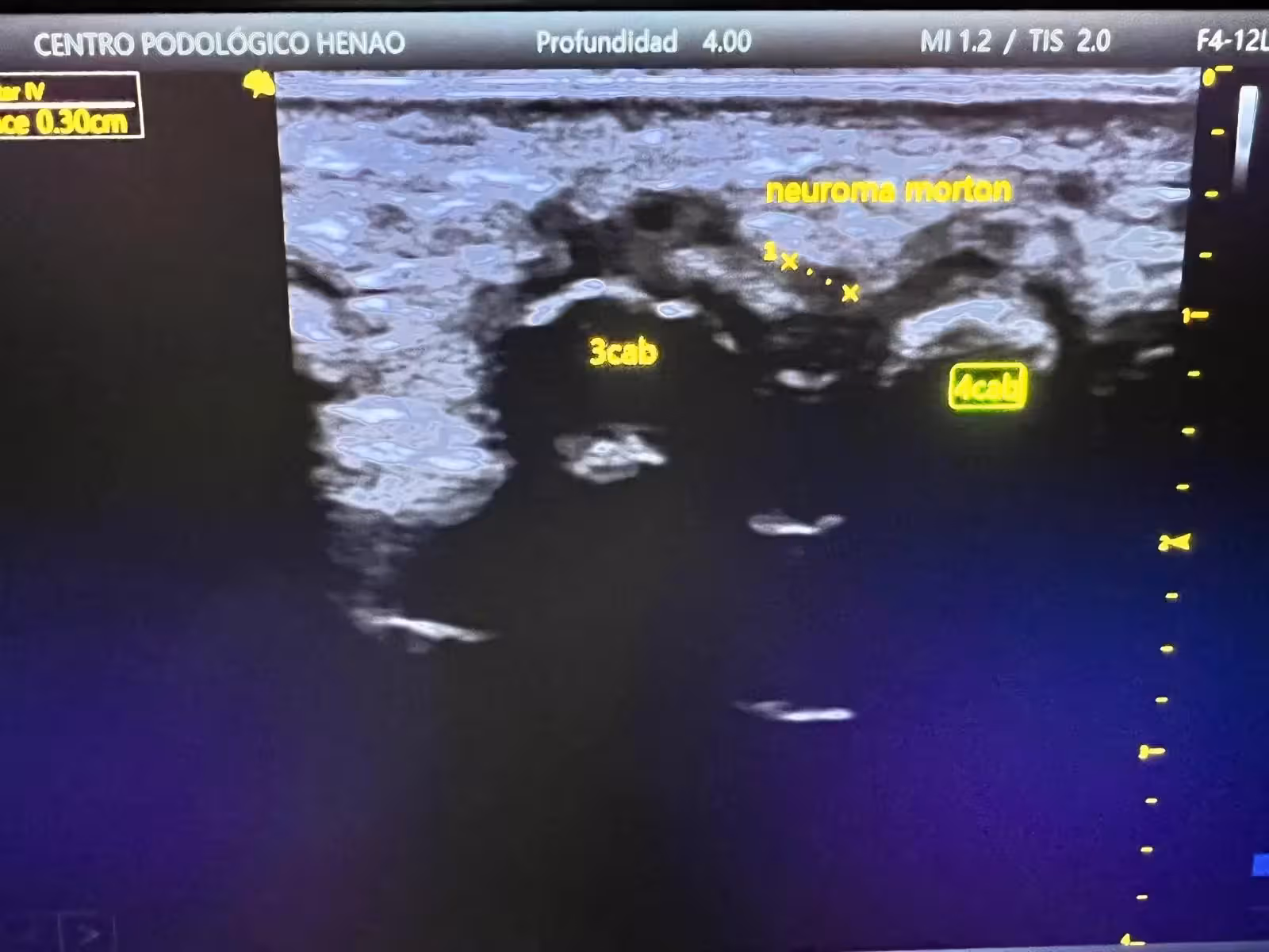 Ecografía de un neuroma de Morton en el antepié realizada en Centro Podológico Henao Bilbao