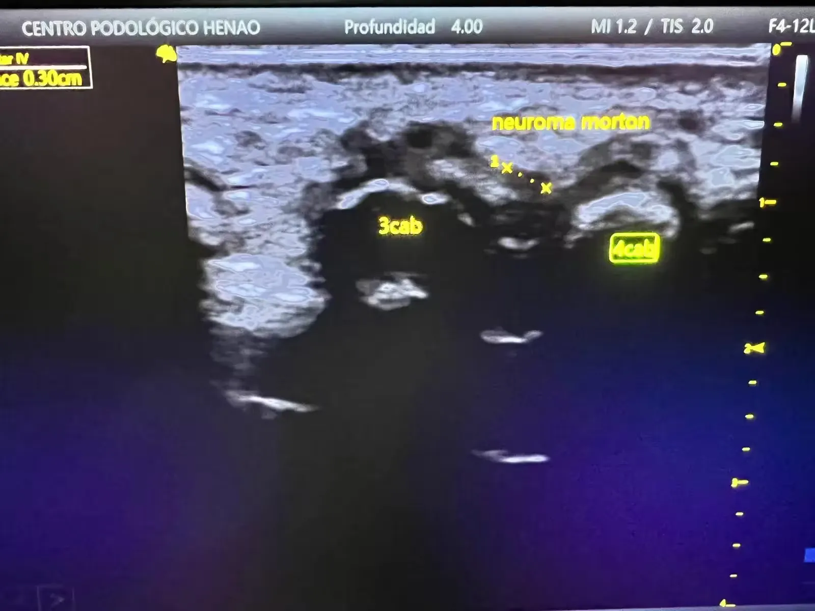 Ecografía de un neuroma de Morton en el antepié realizada en Centro Podológico Henao Bilbao